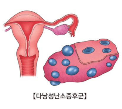 ▲다낭성난소증후군은 그 어떤 이유로(인슐린 효율성 떨어지거나 급격한 체중변화가 있었거나 등등) 시상하부-뇌하수체-난소축으로 연관되는 호르몬 분비에 문제가 생겨서 배란불균형에 빠진 상태