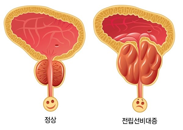 ​사진출처=강동경희대학교병원 비뇨의학과사진출처=강동경희대학교병원 비뇨의학과​